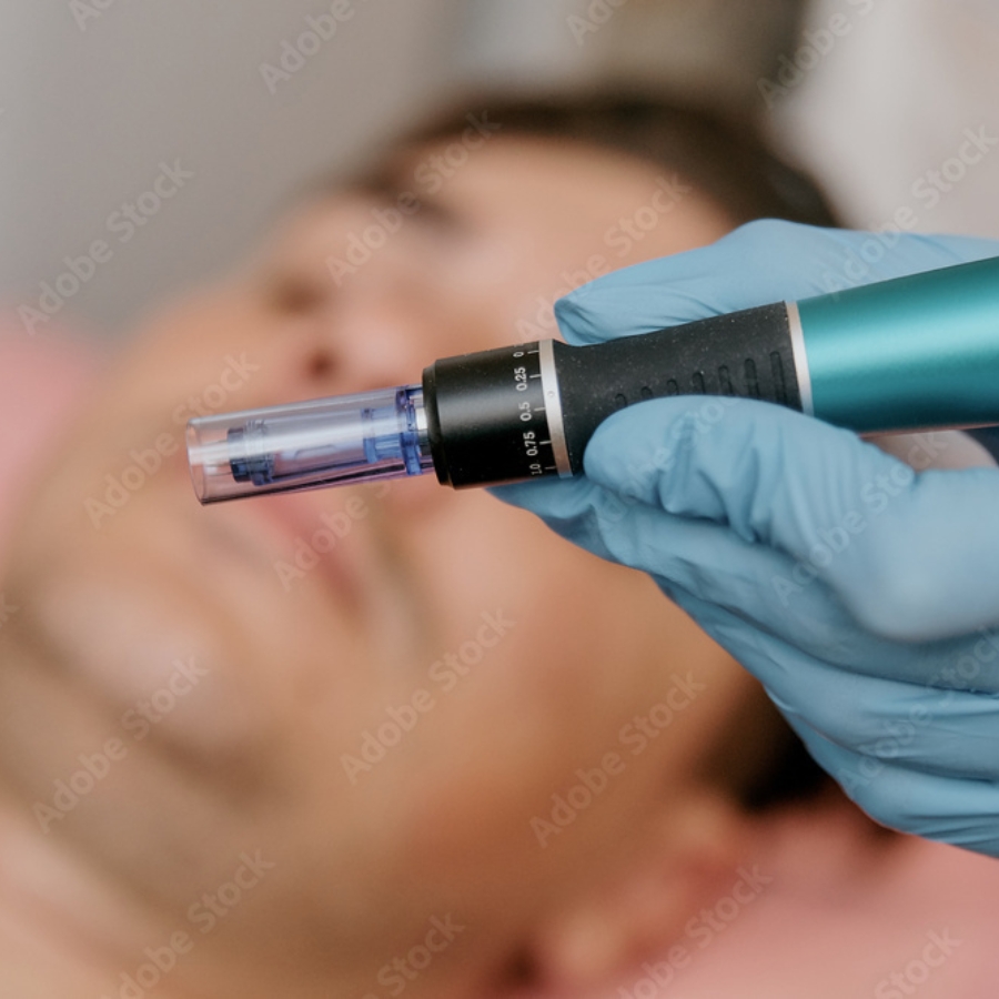 microneedling-treatments-for-men-louisville-co-1-draft microneedling-treatments-for-men-louisville-co-1-draft