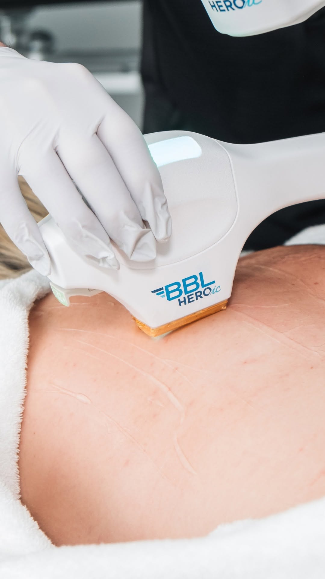 Gloved technician applying a BBL HEROic hair/skin treatment device to a patient’s chest area.